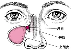 治鼻窦炎药效果好吗